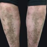 Light brown hyperpigmented patches on the anterior aspect of the lower legs in a patient with MYH9-related disorder.