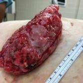 Fungating mass on the abdominal wall