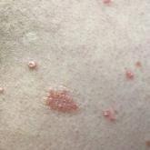 Guttate psoriasis that manifested as erythematous, silvery, scaly papules 3 weeks after COVID-19 infection