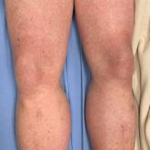 Angioimmunoblastic T-cell Lymphoma Mimicking DRESS Syndrome