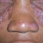 Discoid Lupus