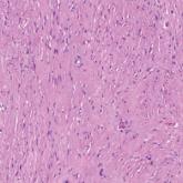 Histopathology of a fully encapsulated schwannoma with cystic areas and hemorrhagic areas 