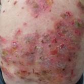 Pemphigus Vulgaris Aggravated: Rifampicin Found at the Scene of the Crime