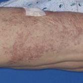 Dermatomal distribution of grouped erythematous papules 