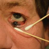 Conjunctival Melanoma of the Left Lower Eyelid