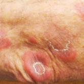 Indurated erythematous papules and plaques on the arm, some with an annular or arcuate configuration with trailing scale