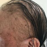 Alopecia with preferential sparing of the occipital scalp.