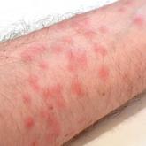 Presentation of diver’s dermatitis on the arm, with distribution limited to an area that was directly exposed to water