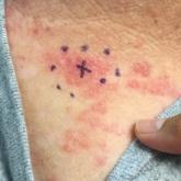  Clavicular region with erythematous papules and plaques at the base of the neck