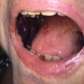 Hemorrhagic bullae of the buccal mucosae Hemorrhagic bullae of the buccal mucosae