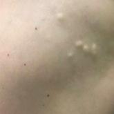 Multiple firm, nontender, flesh-colored to white nodules on the thigh