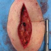 Assisted wound edge approximation utilizing a surgical assistant for bidirectional wound apices traction method for contralateral second pass suture location
