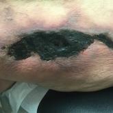 Tender nonhealing lesion on the leg