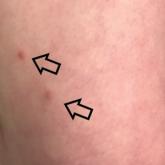 Multiple Eruptive Dermatofibromas Associated With Down Syndrome