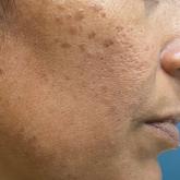 Pigmented papules on the face