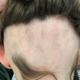 Unique Treatment for Alopecia Areata Combining Epinephrine With an Intralesional Steroid