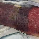 Erythema on the dorsal aspect of the left hand and forearm with a well-demarcated, dusky blue hue, surrounded by an erythematous border on the proximal forearm and upper arm.