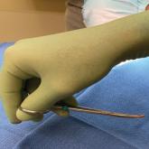 Reverse-Grip Technique of Scissors in Dermatologic Surgery: Tips to Improve Undermining Efficiency