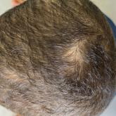 A 10-year-old boy with the black dot type of tinea capitis. A 10-year-old boy with the black dot type of tinea capitis.