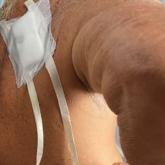 Case patient wearing prototype #1, an easy-removal pulltab bandage. Case patient wearing prototype #1, an easy-removal pulltab bandage.