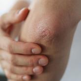 Atopic dermatitis Atopic dermatitis