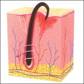 Pseudofolliculitis barbae has been associated with shaving Pseudofolliculitis barbae has been associated with shaving