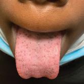 Hyperpigmented papules on the tongue of a child