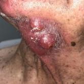 Patient 8 before treatment with a cluster of tumors on the neck 2.5 to 6 cm in diameter