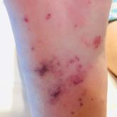 Right plantar foot with a purpuric stellate patch