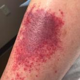 Erythematous edematous papules resembling petechial and purpuric lesions on the right shin