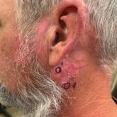 Chronic erythematous plaques around the ears