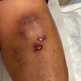 Violaceous nodules on the leg in a patient with HIV