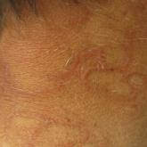 Annular plaques overlying hyperpigmented telangiectatic patches on the neck