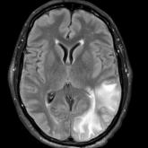 Magnetic resonance imaging of the brain obtained in the emergency department at the time of presentation showed innumerable peripherally distributed foci of microhemorrhage and vasogenic edema within the left parietal-occipital-temporal lobes. Magnetic resonance imaging of the brain obtained in the emergency department at the time of presentation showed innumerable peripherally distributed foci of microhemorrhage and vasogenic edema within the left parietal-occipital-temporal lobes.