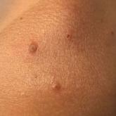 Centrally umbilicated crusted papules on the left shoulder overlying hyperpigmented sun-exposed skin, sparing sun-protected skin. Centrally umbilicated crusted papules on the left shoulder overlying hyperpigmented sun-exposed skin, sparing sun-protected skin.