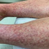 Erythematous to purpuric telangiectases on the lower legs of a 40-year-old woman with generalized essential telangiectasia prior to starting pulsed dye laser therapy. Erythematous to purpuric telangiectases on the lower legs of a 40-year-old woman with generalized essential telangiectasia prior to starting pulsed dye laser therapy.