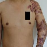 Progressive primary cutaneous nocardiosis