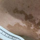Acute Onset of Vitiligolike Depigmentation After Nivolumab Therapy for Systemic Melanoma