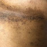 Hailey-Hailey disease under the breast at presentation and 9 months after initiating treatment with onabotulinumtoxinA, respectively.