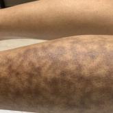 Biopsy-proven erythema ab igne in a patient with darker skin. Biopsy-proven erythema ab igne in a patient with darker skin.