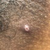 Mpox (monkeypox) papule. Mpox (monkeypox) papule.