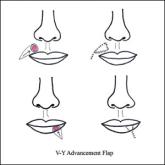 Illustrations of flaps for lip reconstruction.