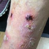 Eruptive keratoacanthomas on the anterior and lateral distal leg, respectively, in a patient with melanoma who was treated with nivolumab.