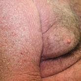 Diffuse erythema and thick yellow scale on the chest, abdomen, and arms.