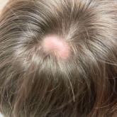 Scalp nodule associated with hair loss