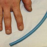 Trachyonychia of the fingernails on the right hand was being treated with painful intralesional triamcinolone injections to the nail matrix, and the patient brought in polyurethane tubing to help with pain management.