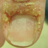 Dyshidroticlike Contact Dermatitis and Paronychia Resulting From a Dip Powder Manicure