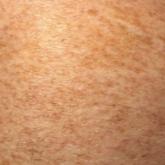 Schamberg disease Schamberg disease
