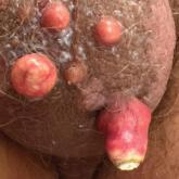 Multiple nodules on the scrotum