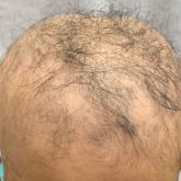 Alopecia areata in a 7-year-old boy